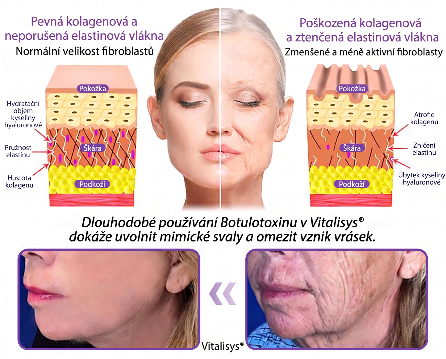 Doporučováno dermatology🥇 | 🍍Vitalisys® PDRN Multi-Peptidový masážní tělový krém – Proti stárnutí, hydratační, zpevňující, regenerační, sjednocující, proti akné a skvrnám, na odstraňování bradavic a mateřských znamének, pro úlevu při lupénce.❤️