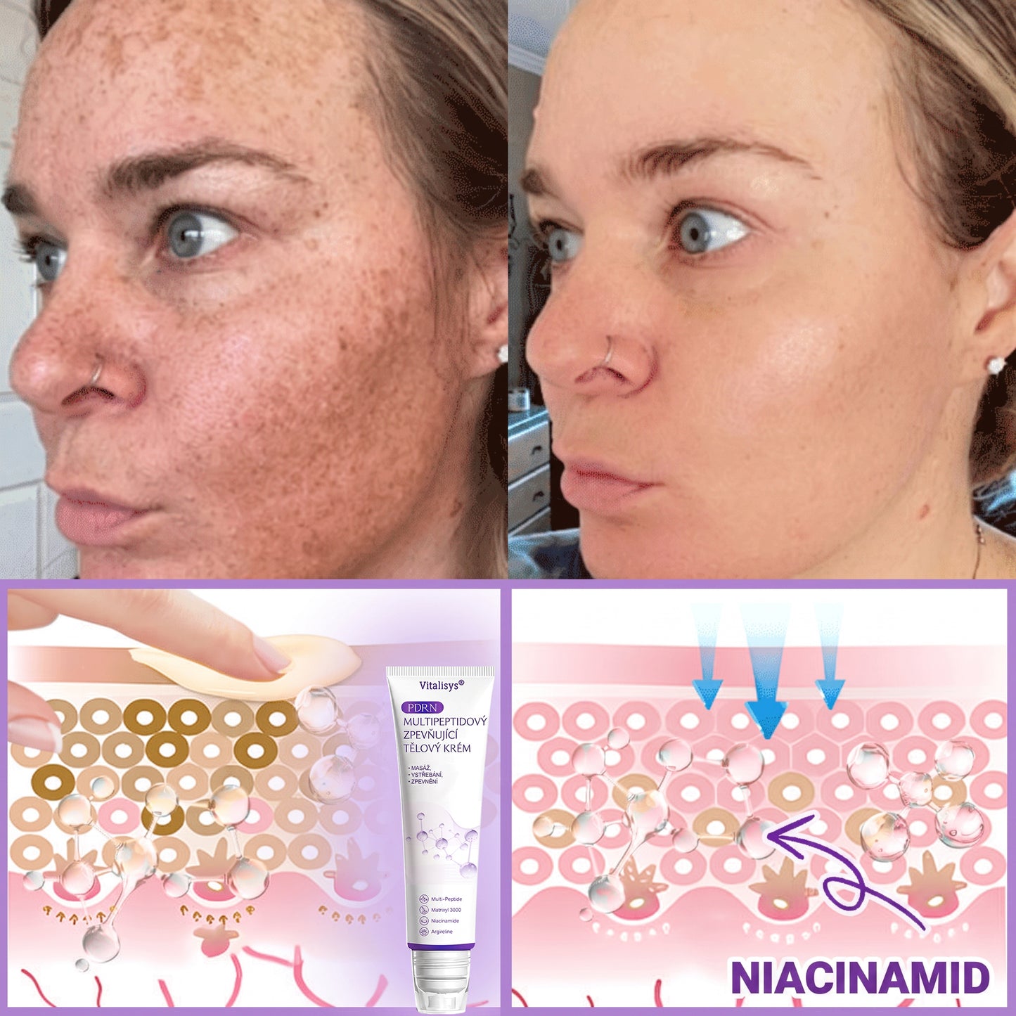 Doporučováno dermatology🥇 | 🍍Vitalisys® PDRN Multi-Peptidový masážní tělový krém – Proti stárnutí, hydratační, zpevňující, regenerační, sjednocující, proti akné a skvrnám, na odstraňování bradavic a mateřských znamének, pro úlevu při lupénce.❤️