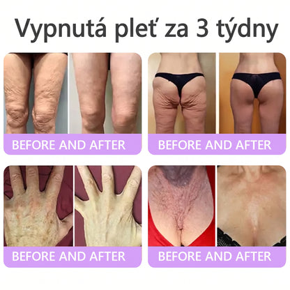 Doporučováno dermatology🥇 | 🍍Vitalisys® PDRN Multi-Peptidový masážní tělový krém – Proti stárnutí, hydratační, zpevňující, regenerační, sjednocující, proti akné a skvrnám, na odstraňování bradavic a mateřských znamének, pro úlevu při lupénce.❤️