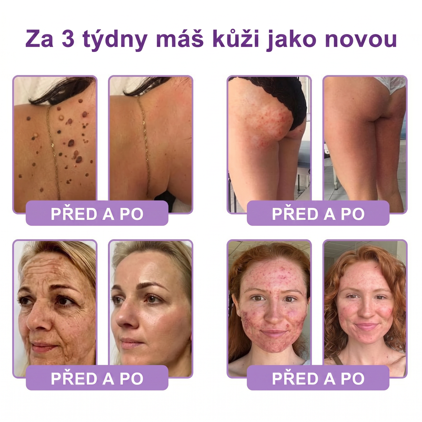 Doporučováno dermatology🥇 | 🍍Vitalisys® PDRN Multi-Peptidový masážní tělový krém – Proti stárnutí, hydratační, zpevňující, regenerační, sjednocující, proti akné a skvrnám, na odstraňování bradavic a mateřských znamének, pro úlevu při lupénce.❤️