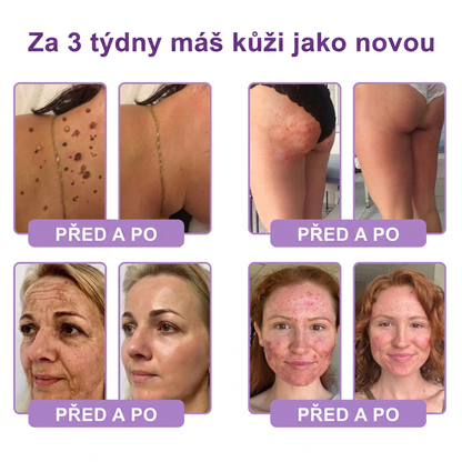 Doporučováno dermatology🥇 | 🍍Vitalisys® PDRN Multi-Peptidový masážní tělový krém – Proti stárnutí, hydratační, zpevňující, regenerační, sjednocující, proti akné a skvrnám, na odstraňování bradavic a mateřských znamének, pro úlevu při lupénce.❤️