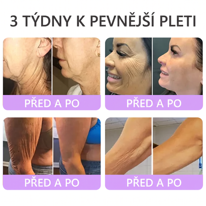 Doporučováno dermatology🥇 | 🍍Vitalisys® PDRN Multi-Peptidový masážní tělový krém – Proti stárnutí, hydratační, zpevňující, regenerační, sjednocující, proti akné a skvrnám, na odstraňování bradavic a mateřských znamének, pro úlevu při lupénce.❤️