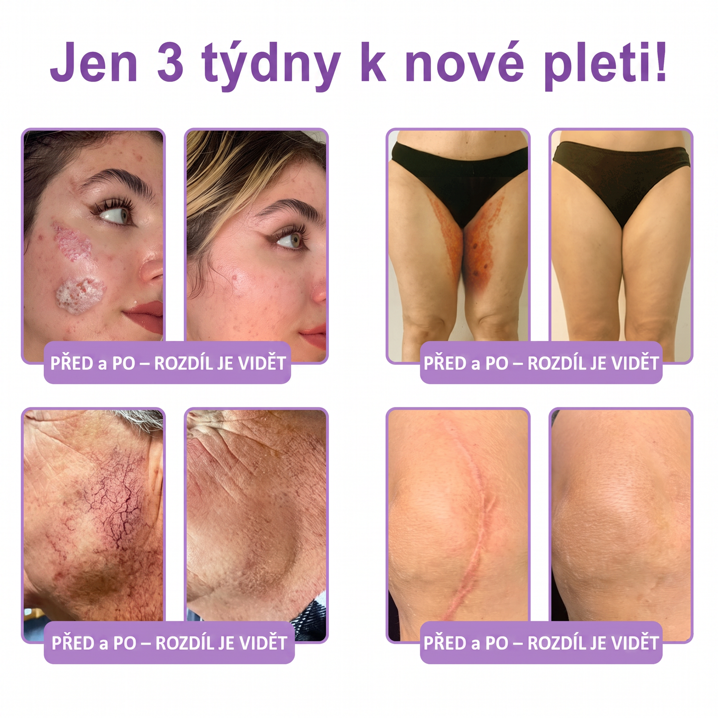 Doporučováno dermatology🥇 | 🍍Vitalisys® PDRN Multi-Peptidový masážní tělový krém – Proti stárnutí, hydratační, zpevňující, regenerační, sjednocující, proti akné a skvrnám, na odstraňování bradavic a mateřských znamének, pro úlevu při lupénce.❤️