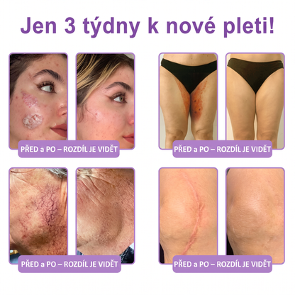 Doporučováno dermatology🥇 | 🍍Vitalisys® PDRN Multi-Peptidový masážní tělový krém – Proti stárnutí, hydratační, zpevňující, regenerační, sjednocující, proti akné a skvrnám, na odstraňování bradavic a mateřských znamének, pro úlevu při lupénce.❤️